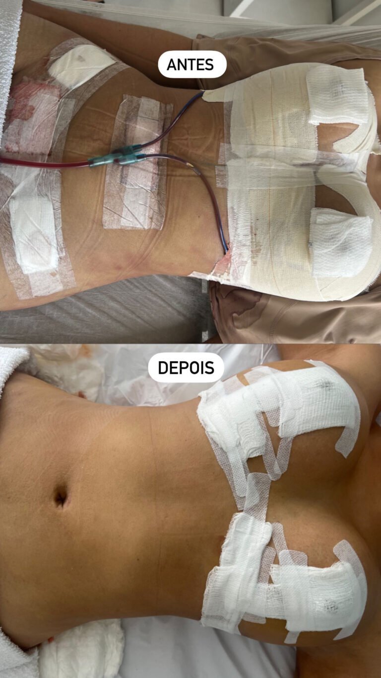 Pós Operatório Corporal