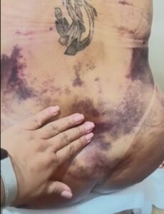 Tratamento de Seroma