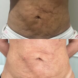 Tratamento de Fibrose
